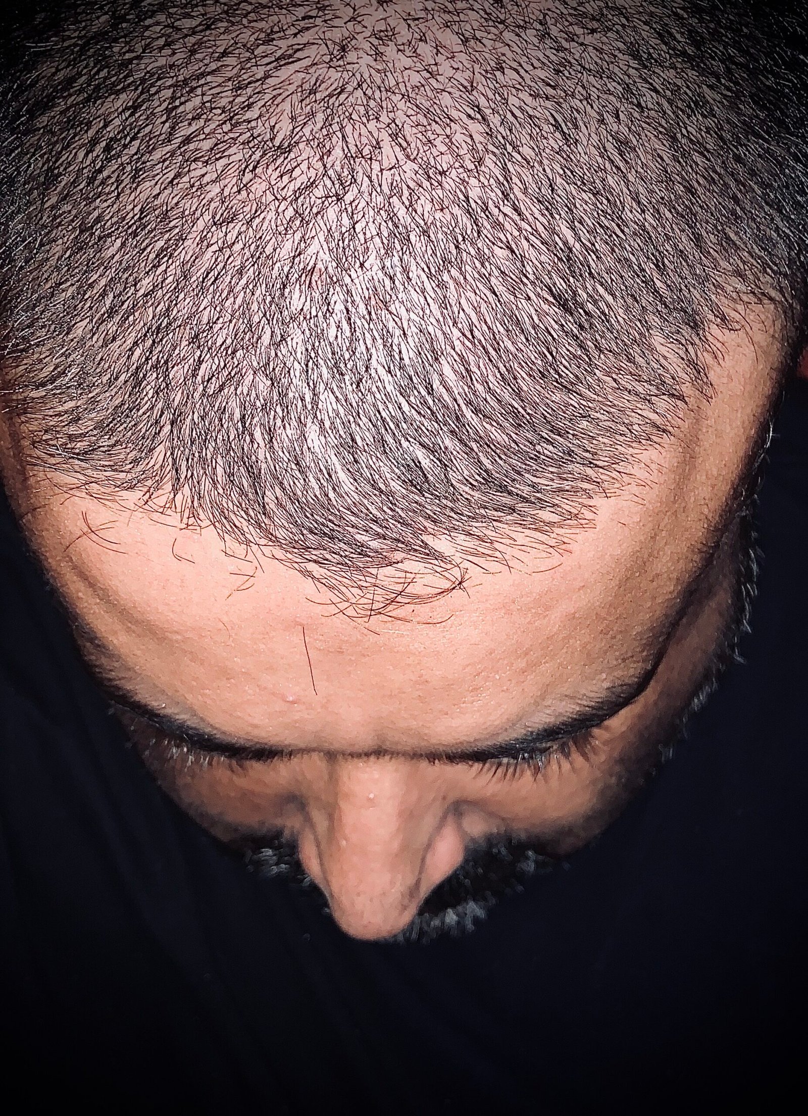 hair-loss-2024-12-07-00-05-54-utc