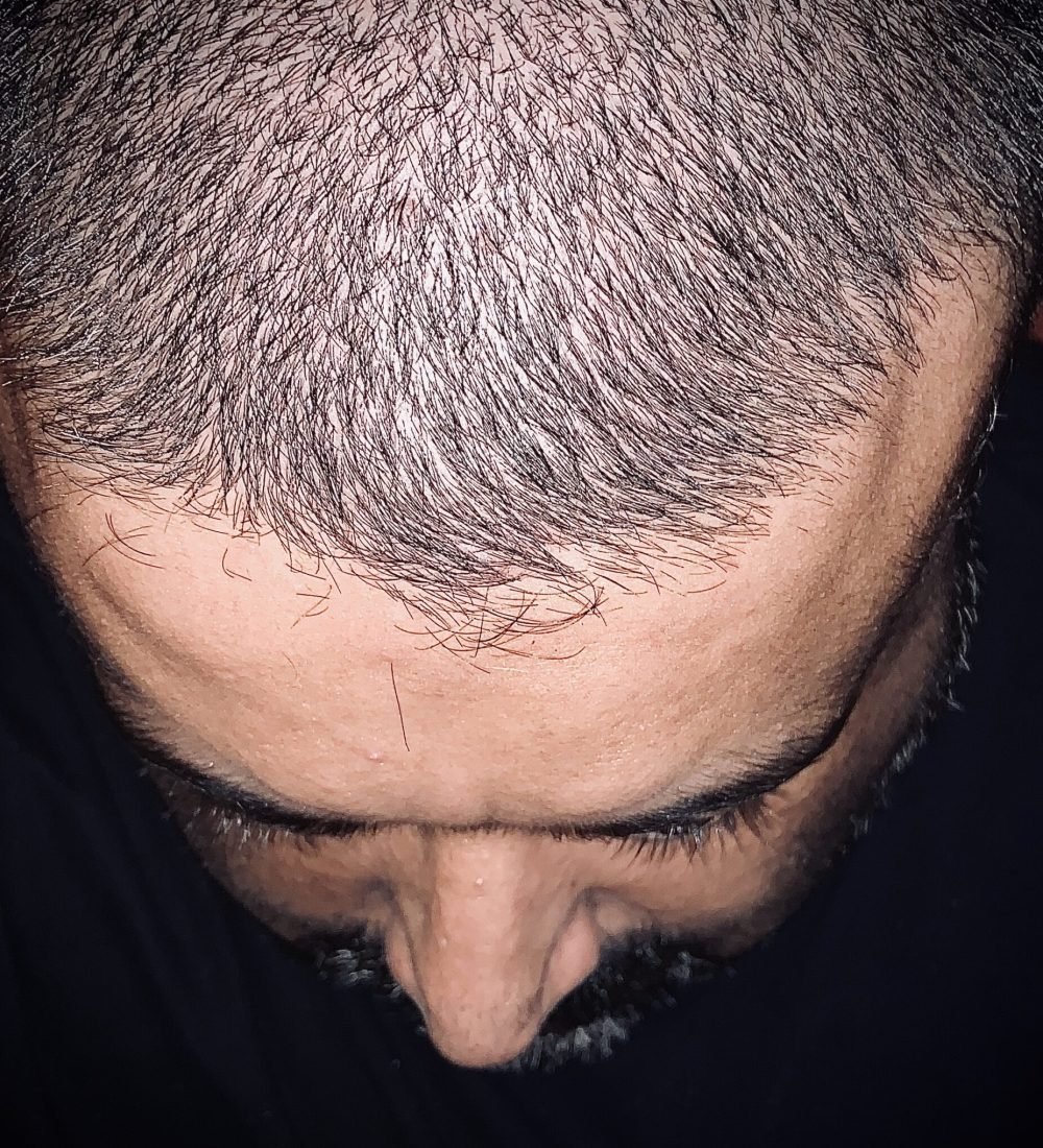 hair-loss-2024-12-07-00-05-54-utc